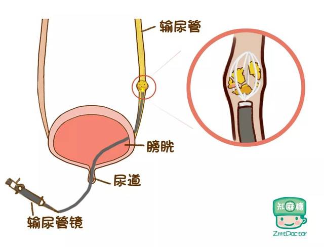 这个叫 输尿管镜下碎石术.