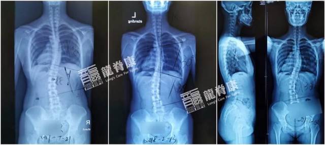 确诊为脊柱侧弯,但只接受了推拿治疗,2年后再拍片,度数没有明显改变