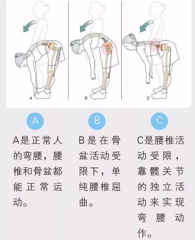 因为,髋部越紧,腰部就越紧,腰大肌的张力就越来越大,有可能会影响下