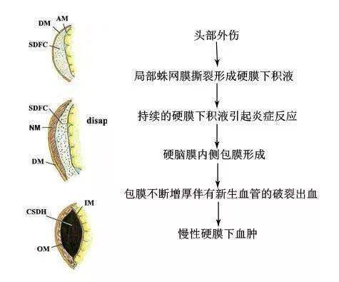 常见易复发,如何应对慢性硬膜下血肿?