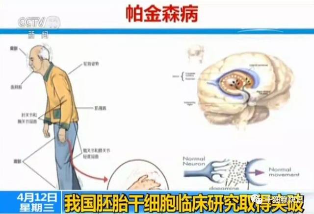 干细胞疗法在帕金森病中临床研究作用