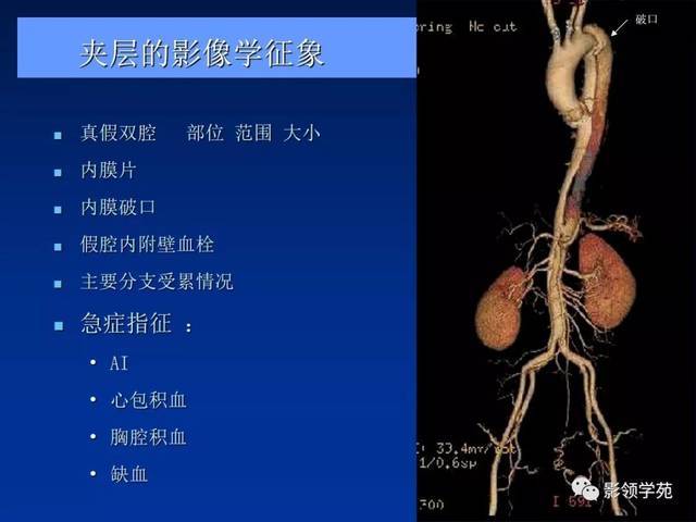 主动脉夹层,壁间血肿及穿通性溃疡影像诊断与鉴别