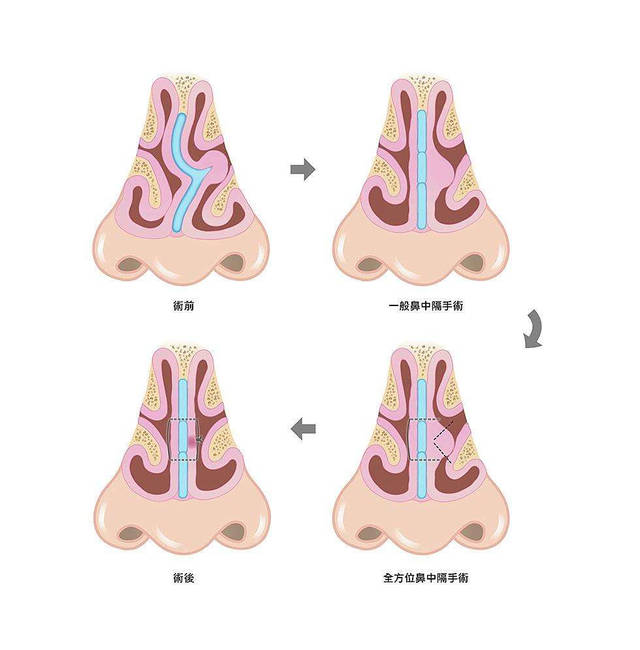在了解鼻中隔偏曲形态的同时,可清晰观察鼻中隔与相邻结构的解剖关系
