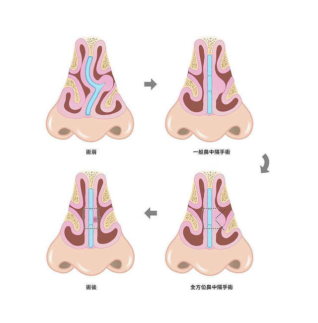 首大李霞:鼻中隔偏曲应该怎么治疗?