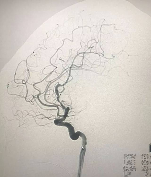 畸形团没显影 毛细血管期