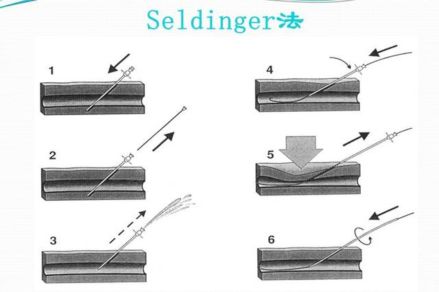 从上往下走也行,比如肱动脉和锁骨下带动脉,采用的方法是seldinger法