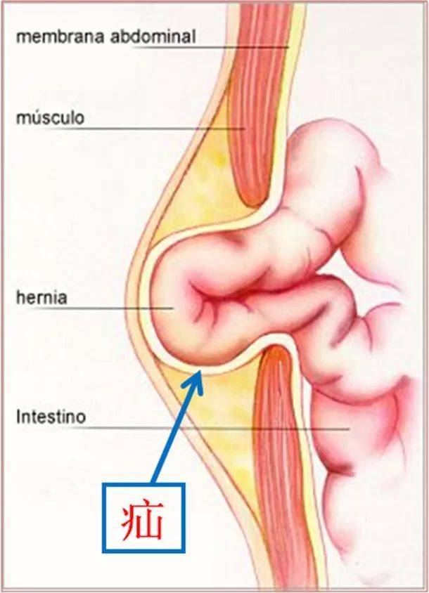 指腹腔内脏器通过腹股沟区的缺损向体表突出所形成的包块,俗称"疝气"