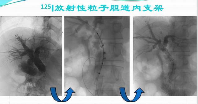 这个是125i粒子的胆道支架.