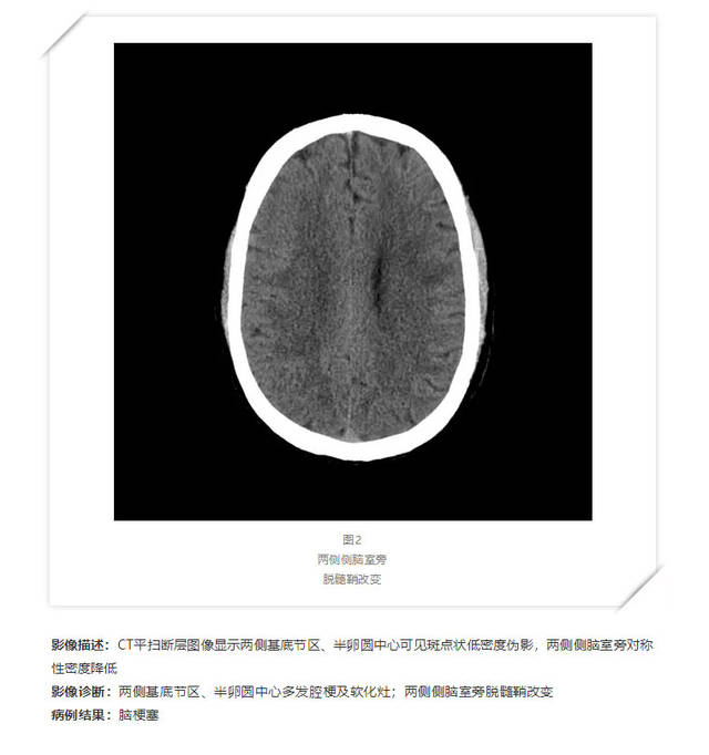 ct检查在脑卒中的应用