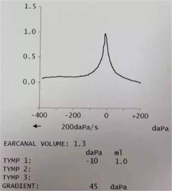 正常鼓室曲线图,两侧基本光滑对称