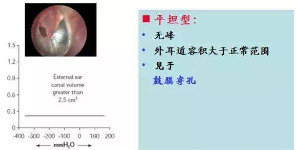 2,c型鼓室图曲线 正常的鼓室曲线图,两侧基本是光滑,且大致对称的,如