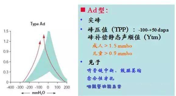 2,c型鼓室图曲线 正常的鼓室曲线图,两侧基本是光滑,且大致对称的,如