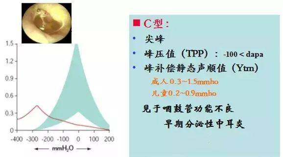 2,c型鼓室图曲线 正常的鼓室曲线图,两侧基本是光滑,且大致对称的,如