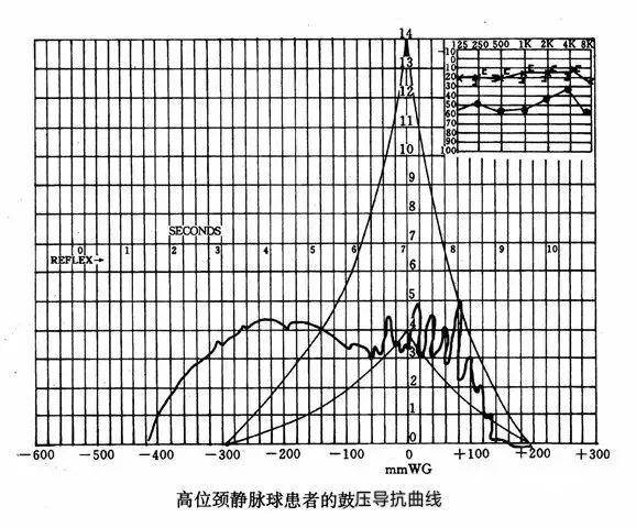 一张鼓室图反映的信息