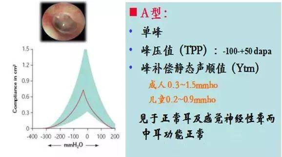 1,a型鼓室图曲线临床上常用的声导抗测试的探测音为226hz的低频和1000