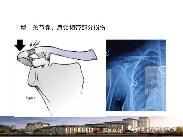 肩锁关节脱位