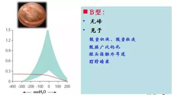 2,c型鼓室图曲线 正常的鼓室曲线图,两侧基本是光滑,且大致对称的,如