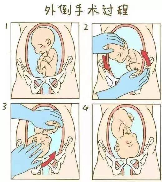 下面我们就来谈谈臀位阴道试产有哪些需要知道的相关事 ..