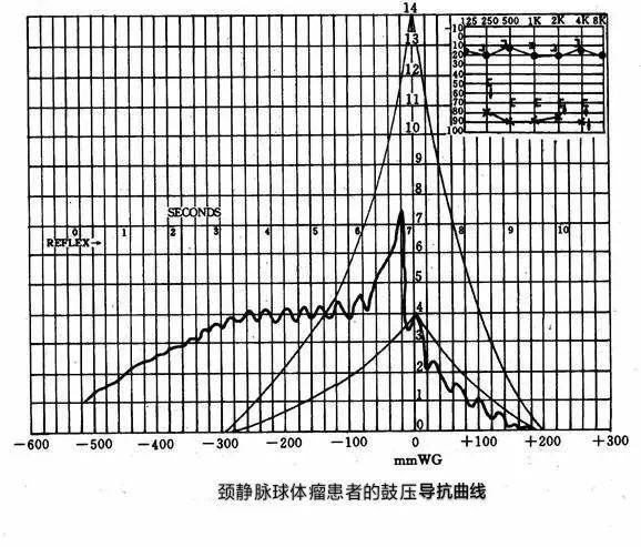 一张鼓室图反映的信息