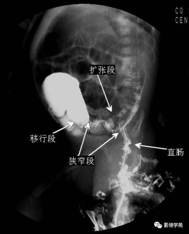 先天性巨结肠的临床与影像学诊断