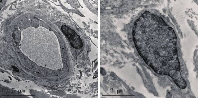 先证者皮肤活体组织检查电镜图,多个动脉血管观察未见嗜锇颗粒沉积