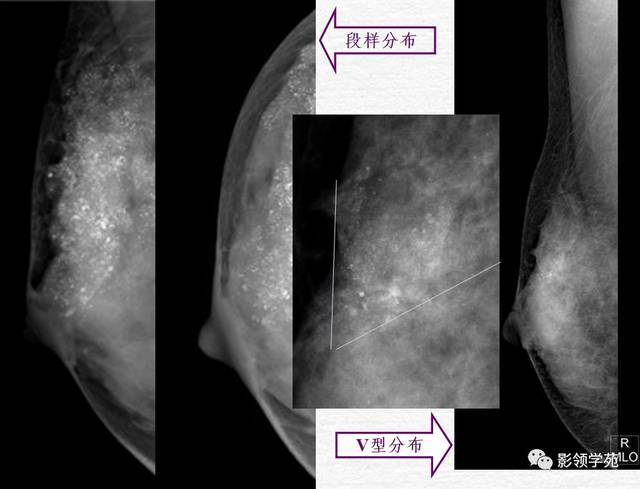 常见乳腺良恶性病变的x线诊断