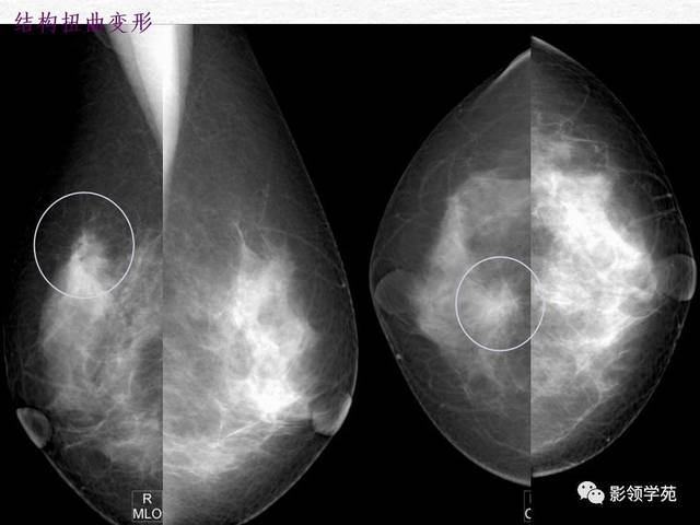 常见乳腺良恶性病变的x线诊断