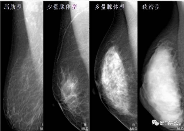 常见乳腺良恶性病变的x线诊断