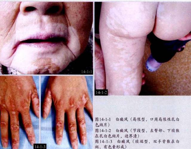 史上最全皮肤病图谱(附治疗方法)