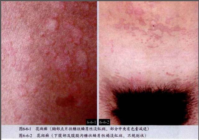 史上最全皮肤病图谱(附治疗方法)