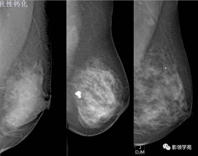 常见乳腺良恶性病变的x线诊断