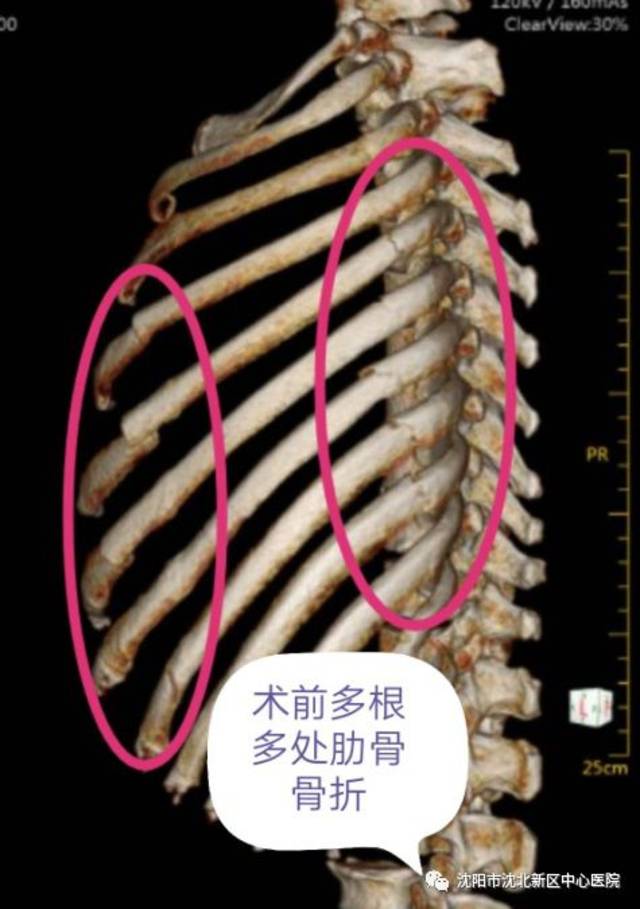 我院胸外科成功实施肋骨多发性骨折切开复位内固定手术