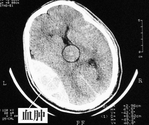 那么脑疝是什么病,这么可怕,就没有办法治疗了吗?