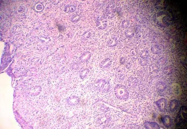 3分钟看懂胃镜活检病理报告,医生一般不会跟你