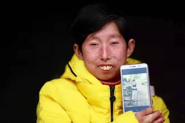 年轻女孩戴着「人皮面具」活了 20 年,全因一场怪病