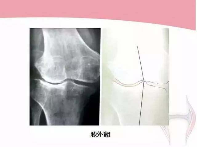 【大荔中医】骨关节炎诊断与治疗