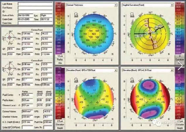【眼科资讯】看完这10条,角膜地形图分析不再是难题!