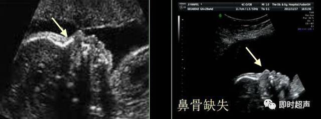 nb筛查时间:11—14周,异常标准:鼻骨缺失,鼻骨短小是染色体异常的超声