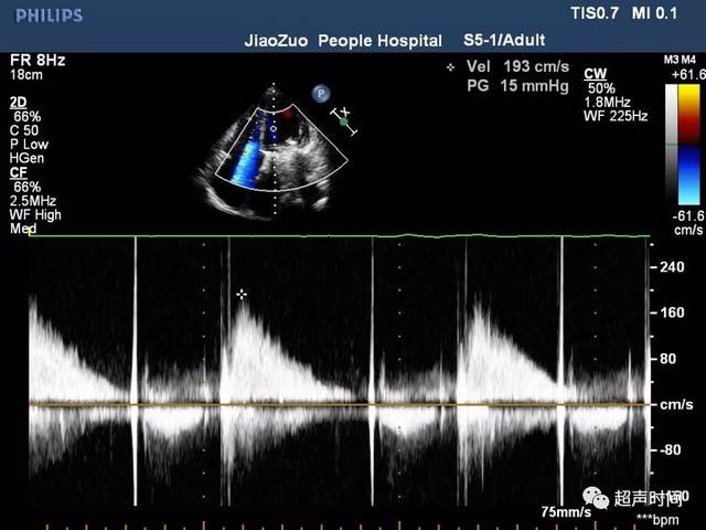 舒张期二尖瓣口红色为主的五彩血流束,起自二尖瓣口,指向左室流出道