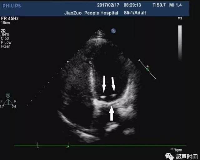 二尖瓣生物瓣置换术后,可见回声较强的瓣环(箭头处),瓣环之间
