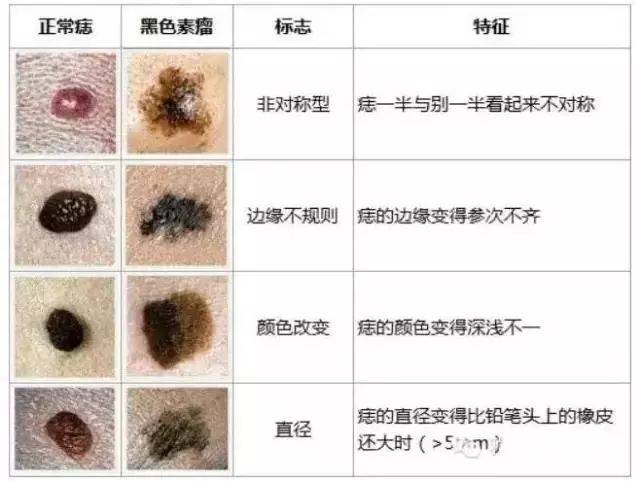 色素痣治疗原则