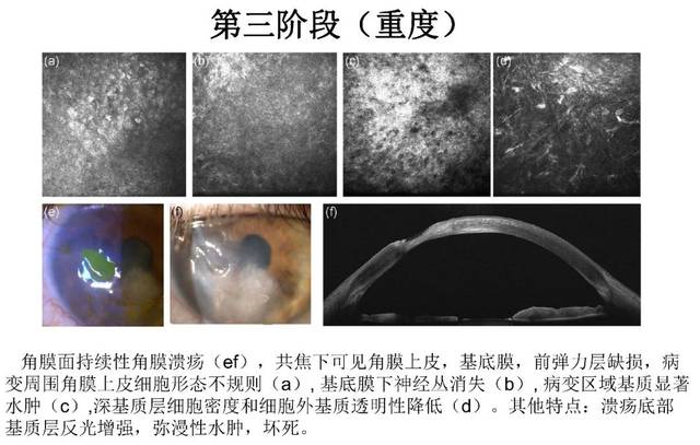 ccos角膜丨陈百华教授:术后角膜病变的共焦显微镜特点
