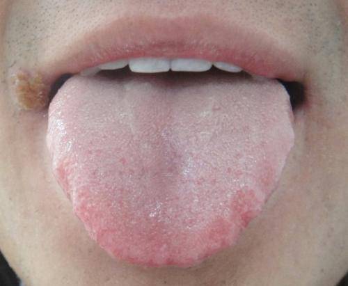 舌头的颜色可以反映出身体的状况,舌头的形态同样与健康息息相关,有