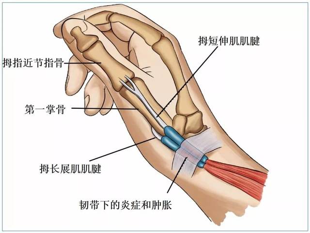 腱鞘就是套在肌腱外面的双层套管样密闭的滑膜管,是保护肌腱的滑液鞘