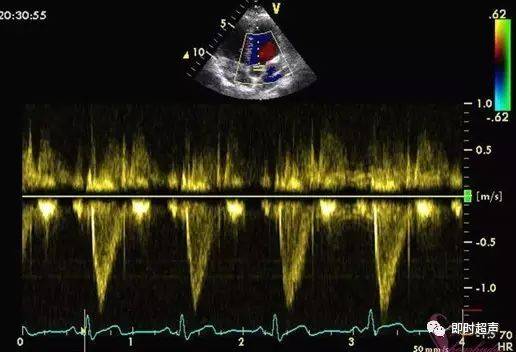 图解二维超声心动图正常值与测量