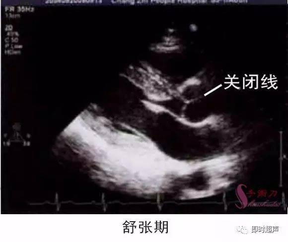 图解二维超声心动图正常值与测量