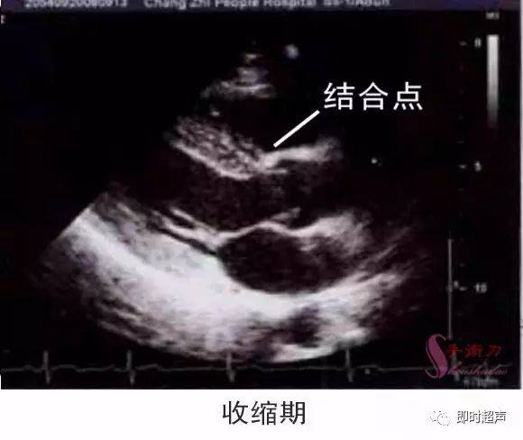 图解二维超声心动图正常值与测量