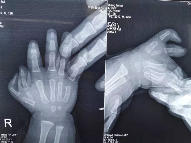 桡神经损伤致垂腕垂指,尺神经损伤致"爪形手";正中神经损伤致"猿手"
