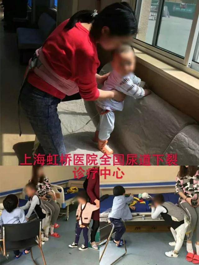 尿道下裂案例分享:重度阴囊型