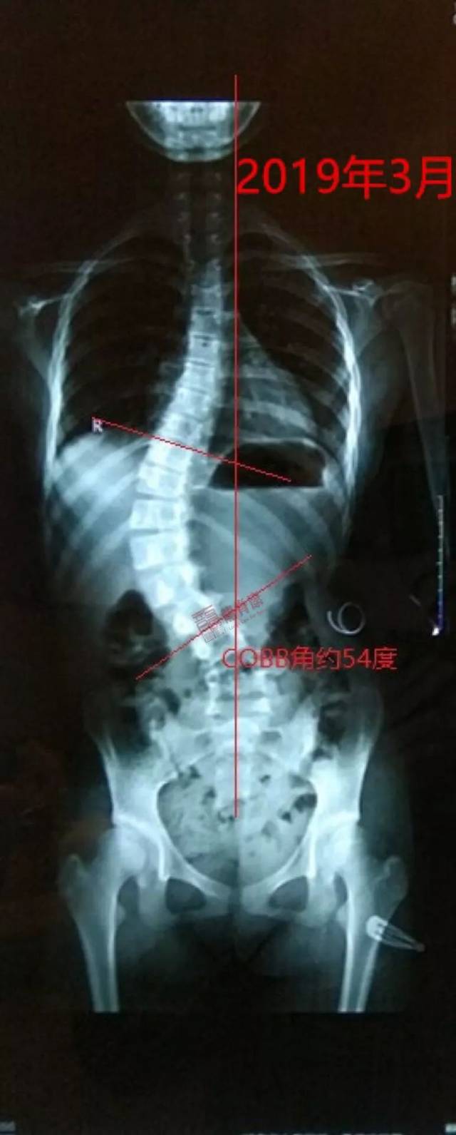 沈主任说脊椎:发现却没尽早干预,11岁脊柱侧弯进展至58°!